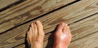 Czy Wkładki na płaskostopie pomagają?